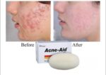 Acne-Aid Bar Soap – 100g | ব্রণ, অয়েল ও দাগমুক্ত ত্বকের জন্য মেডিকেটেড সাবান